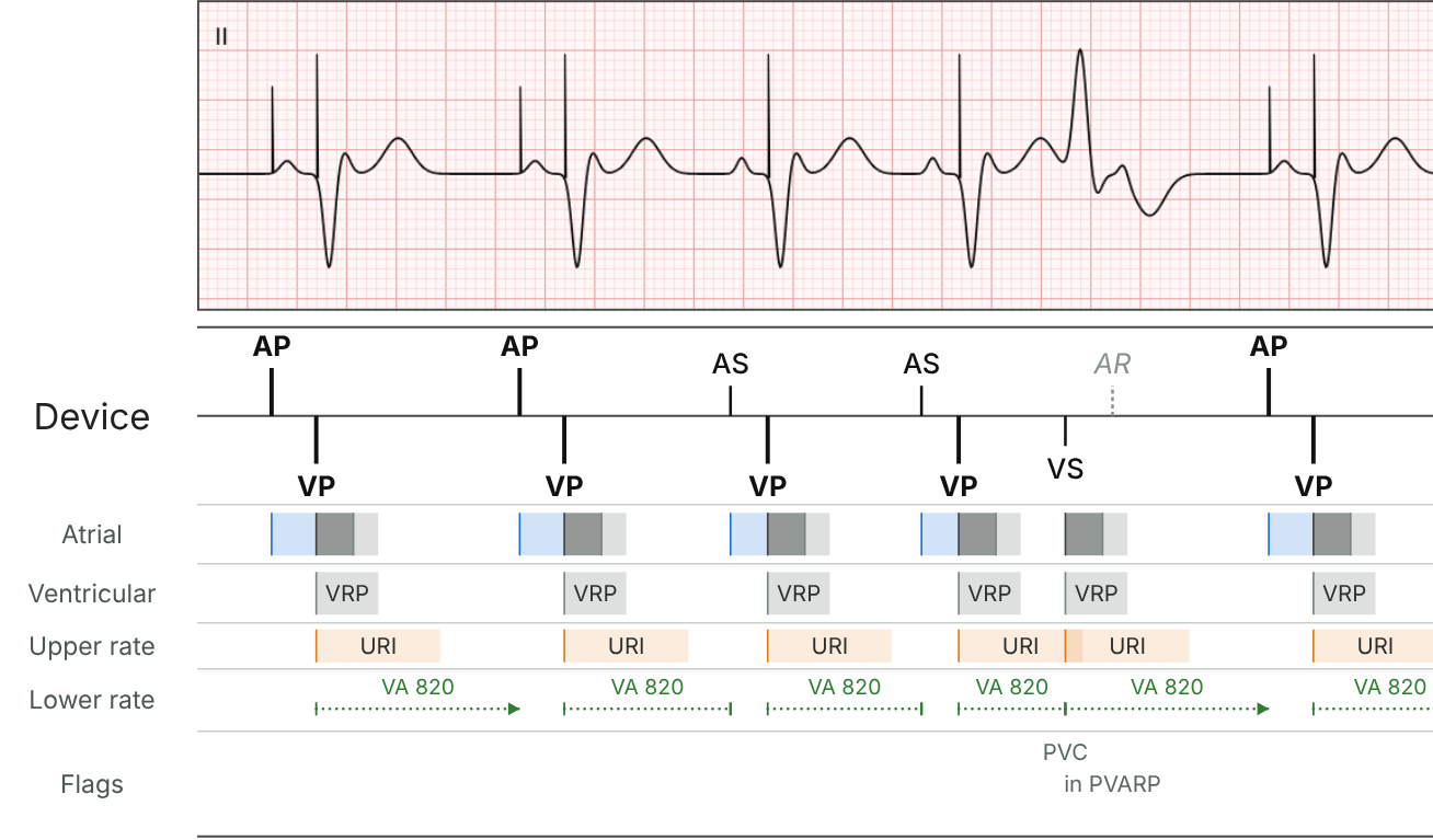 First half of the DDD example: AP-VP pacing at the lower rate, then sinus P waves tracked (AS-VP), then a PVC (VS) whose next P wave falls in PVARP (AR) and isn't tracked, so the atrium is paced again (AP) at the VA interval from the PVC.