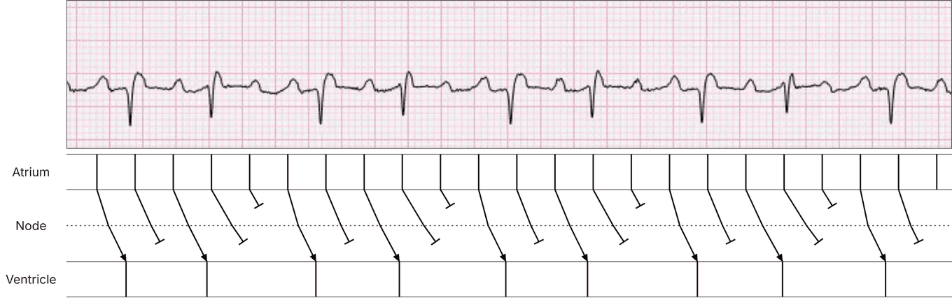 Laddergram of atrial flutter with 5:2 conduction: 5:4 Wenckebach in the upper AV node over 2:1 block in the lower AV node.