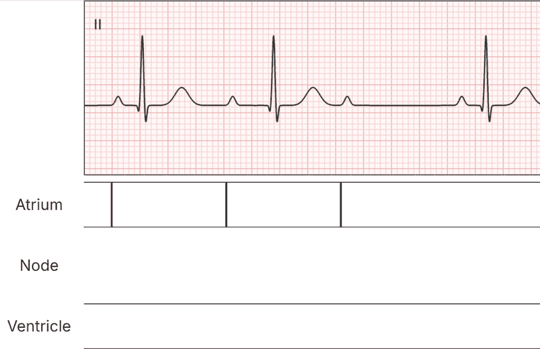 Step 1: one atrial impulse on each P wave of the cycle.