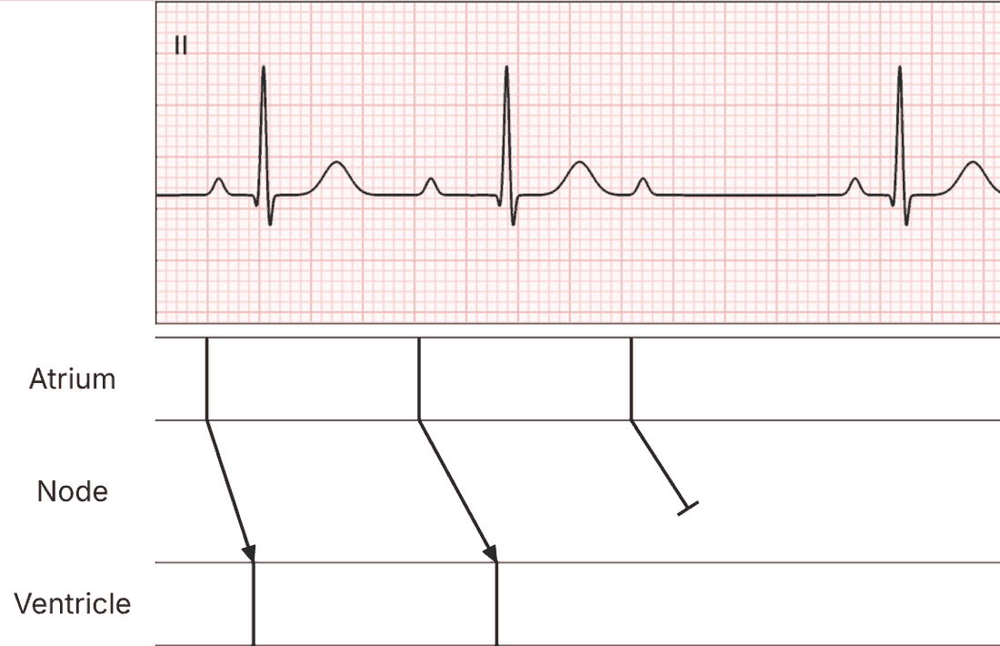Step 4: the third P wave blocks in the AV node. One cycle complete.